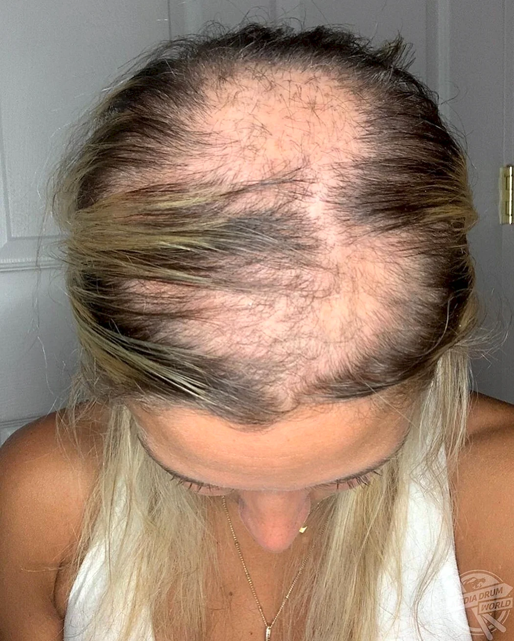 Гніздна алопеція офіазис