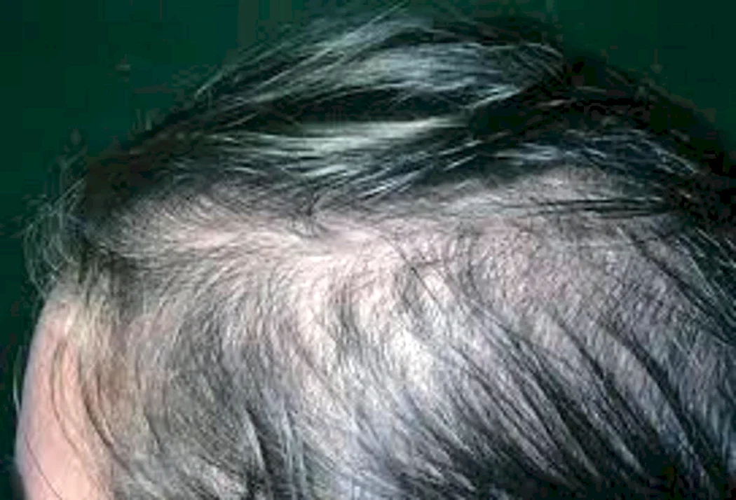 Андрогензалежна алопеція