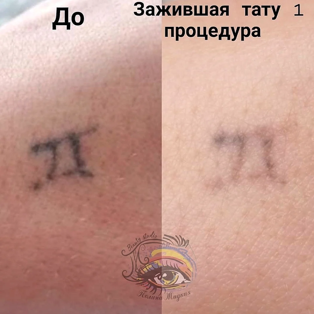 Неправильное заживление Татуировки