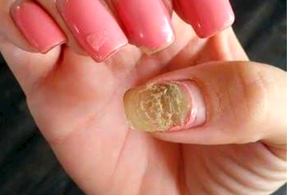 Синегнойная Псевдомония