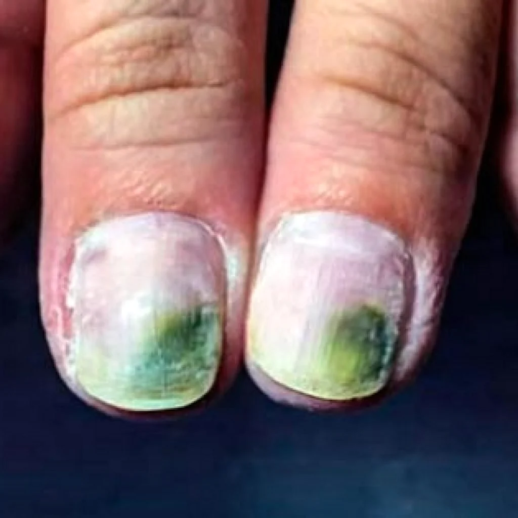 Синегнойная палочка Псевдомония