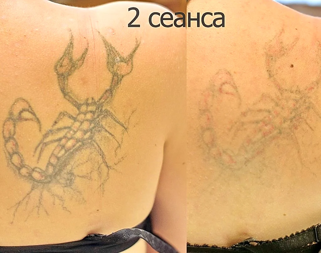 Лазерное сведение тату