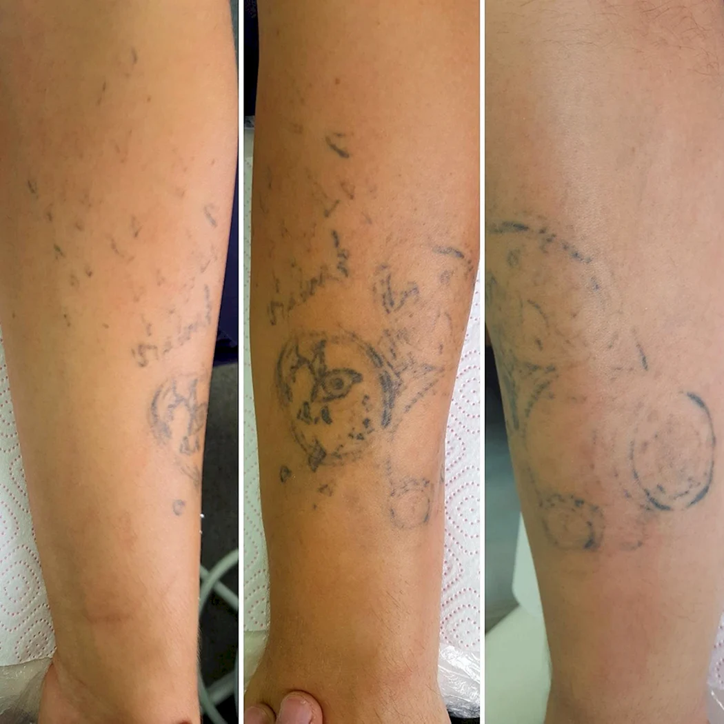 Сведение тату лазером до и после