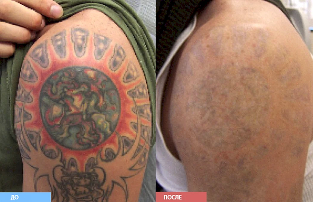 Сведение тату до и после