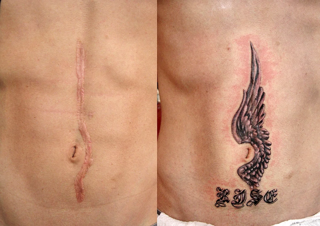 Келоидный рубец шрамирование