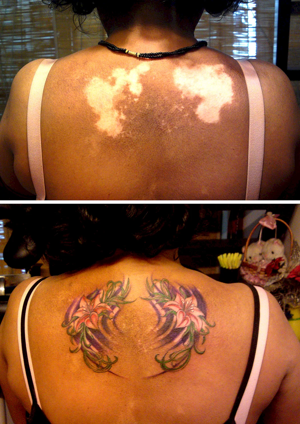 Микропигментация витилиго