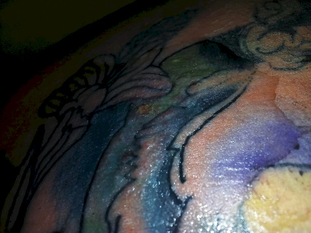 Маленькие прыщики на татуировке