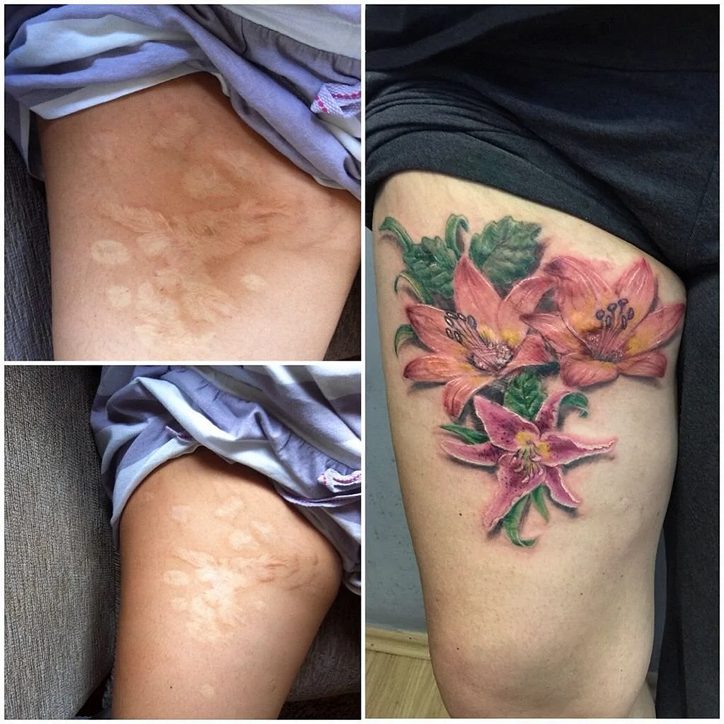 Перекрытие шрамов татуировкой