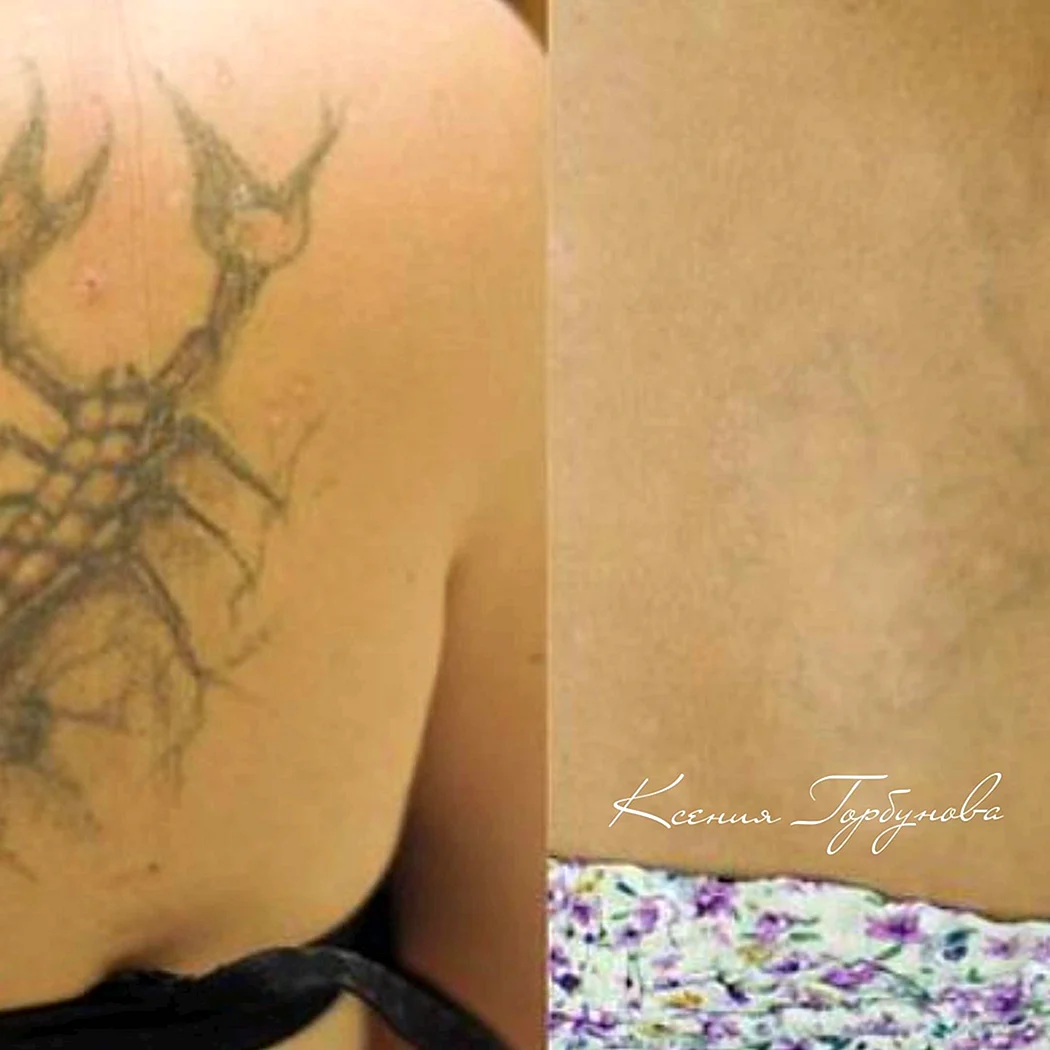 Тату после сведения лазером