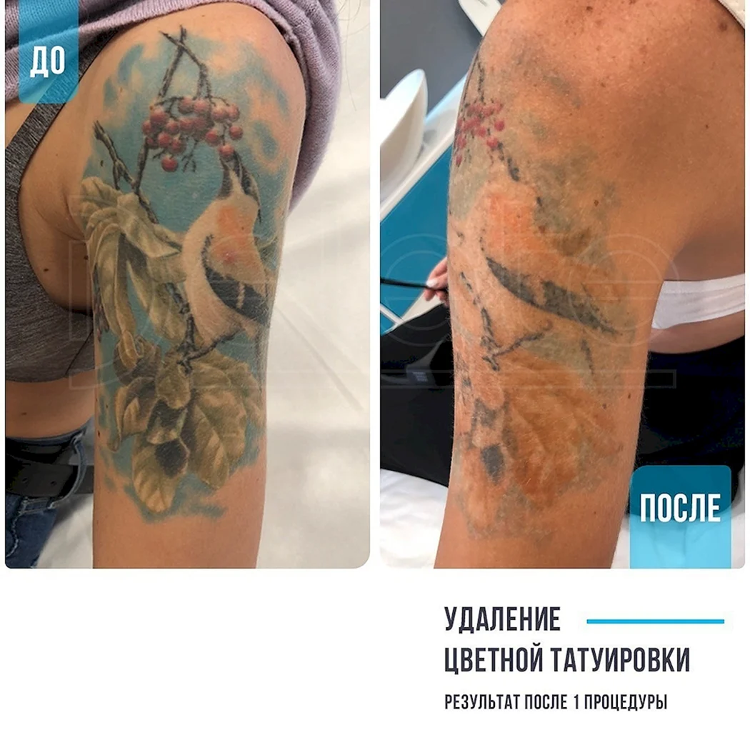 Сведение цветной тату лазером