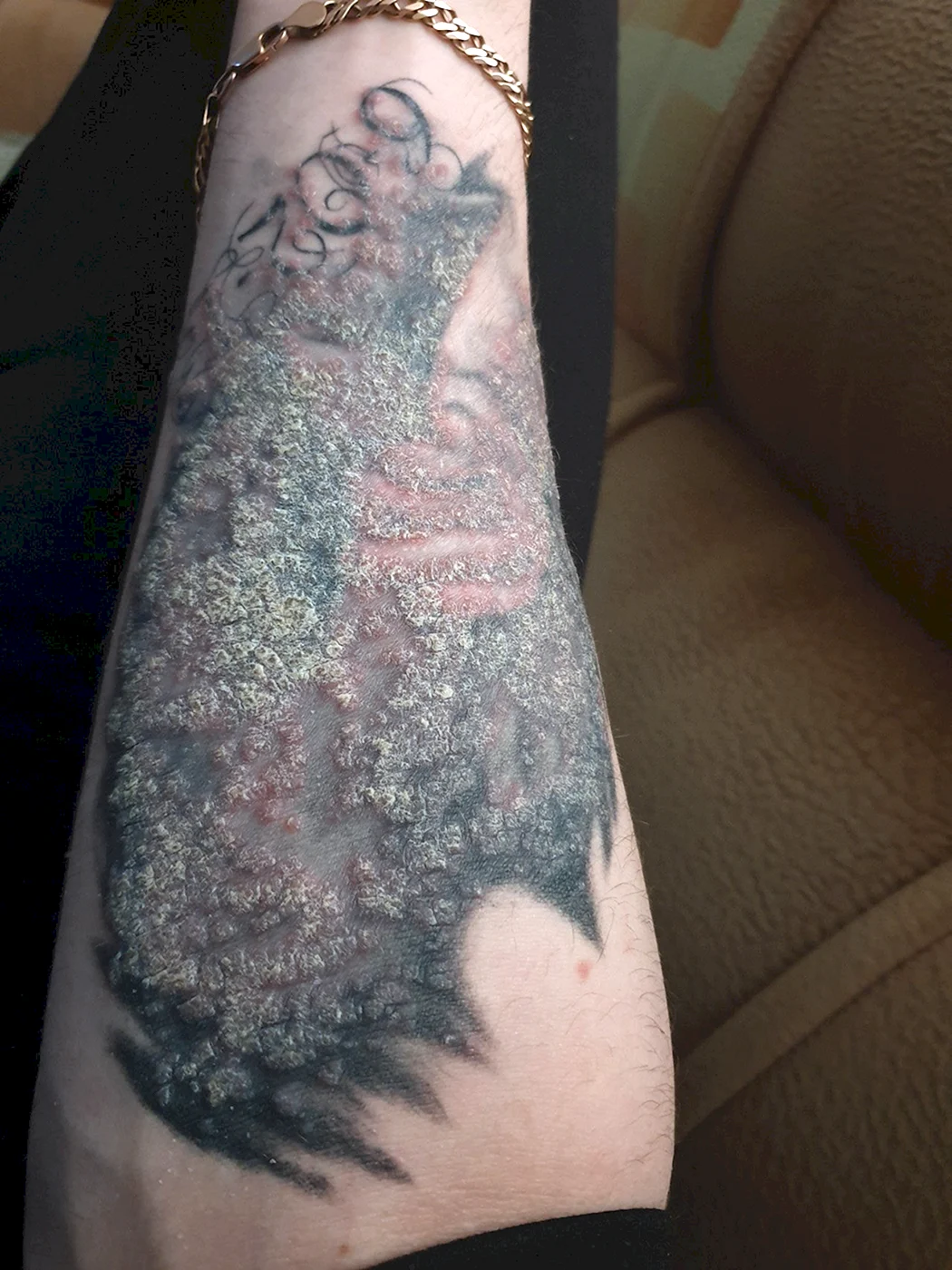 Маленькие прыщики на татуировке