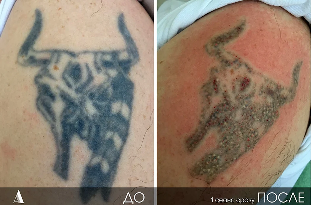 Сведение тату лазером до и после