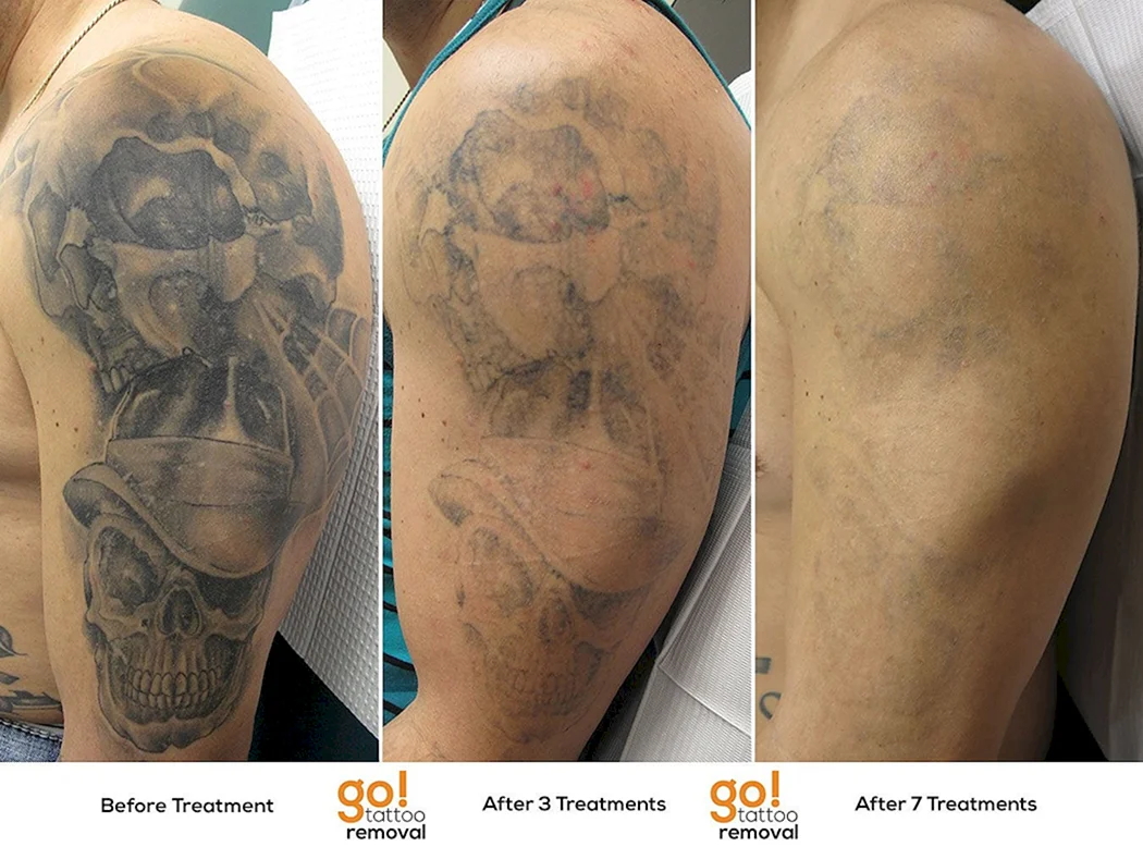 Неправильно зажившие тату