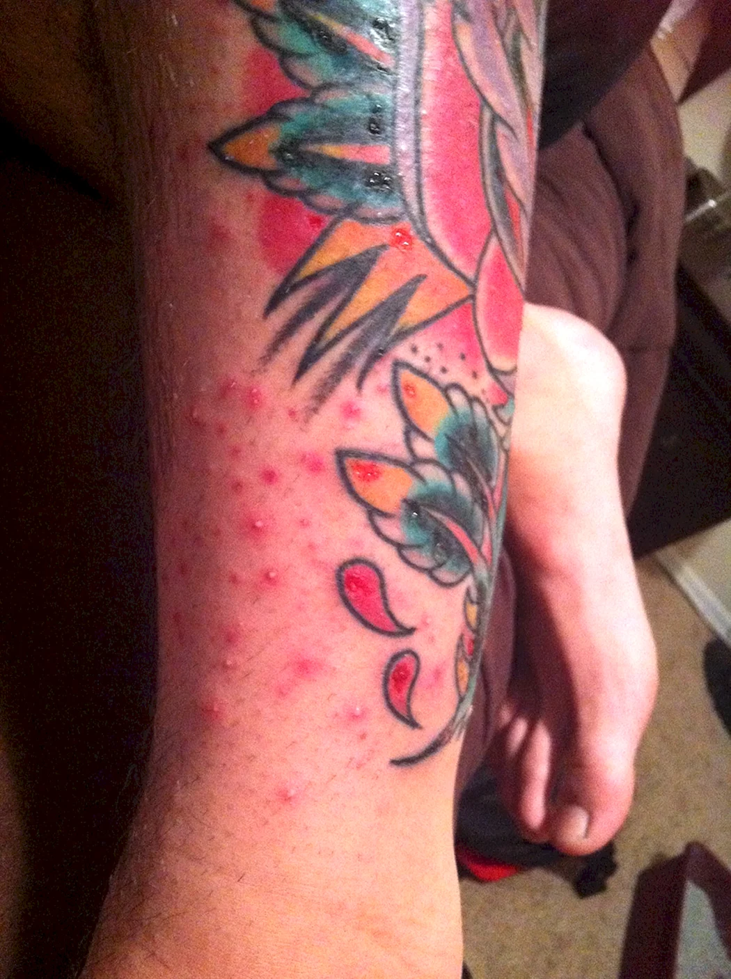 Аллергическая реакция на тату