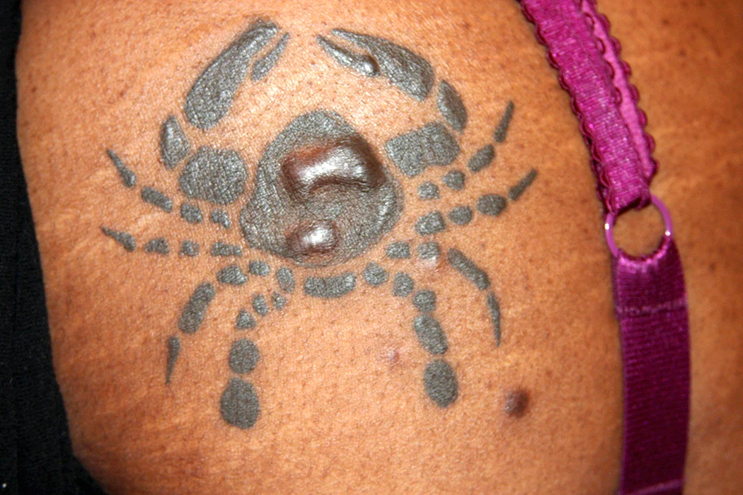 Раздражение на татуировке