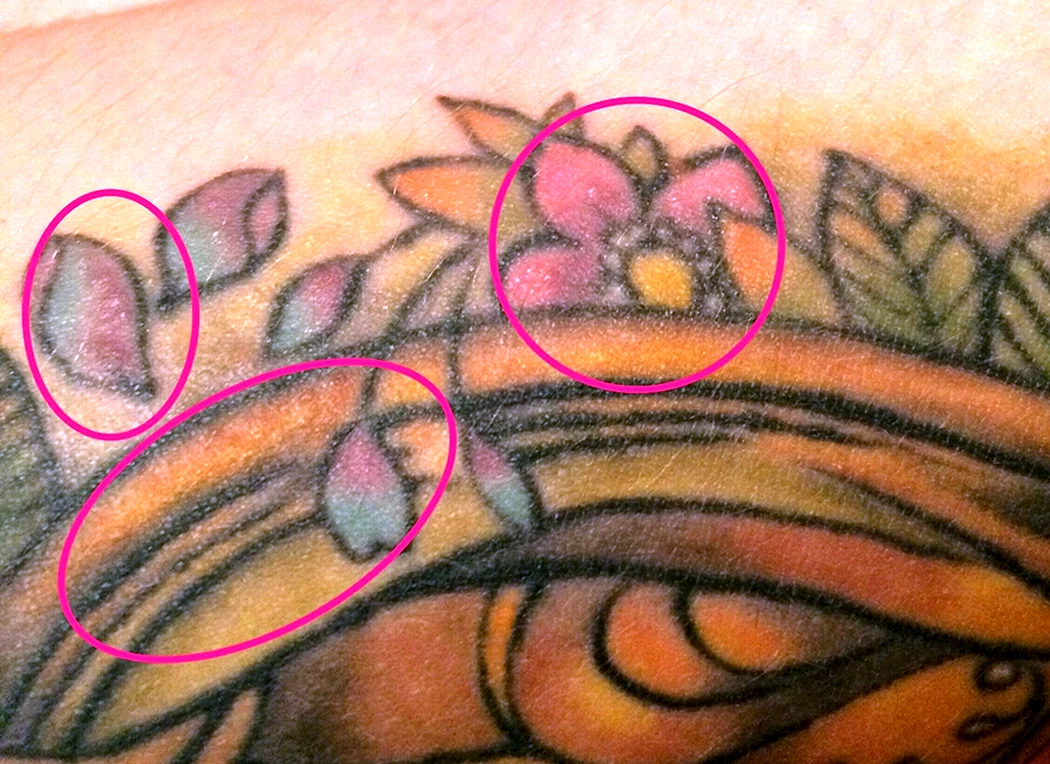 Высыпания на татуировке