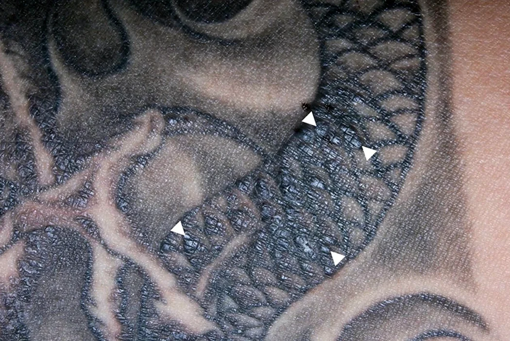 Кожные заболевания тату