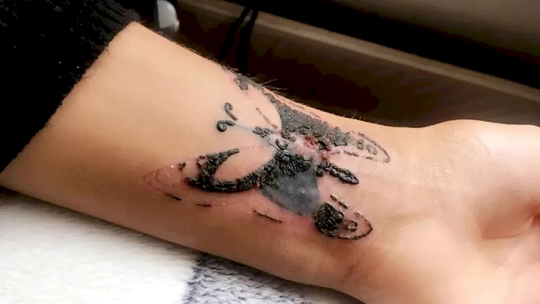 Инфекция после Татуировки