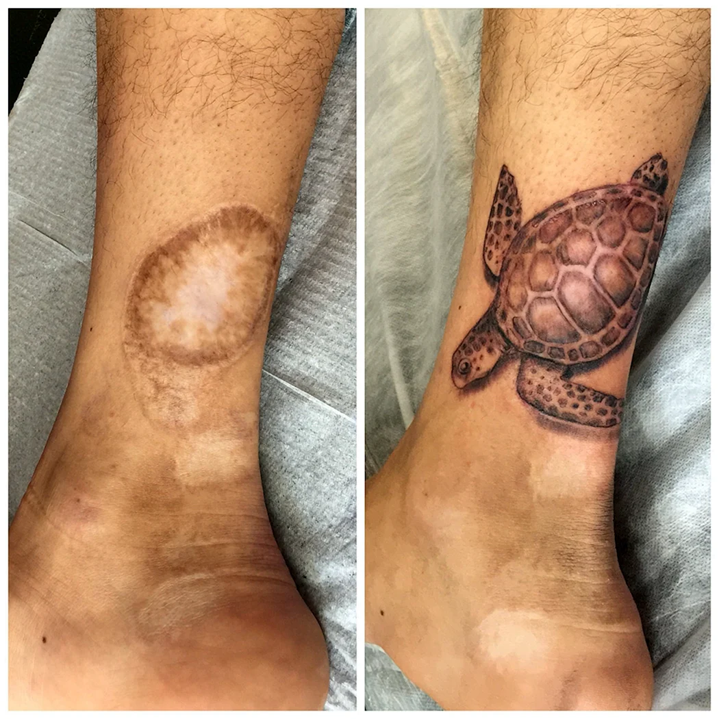 Перекрывание шрамов тату