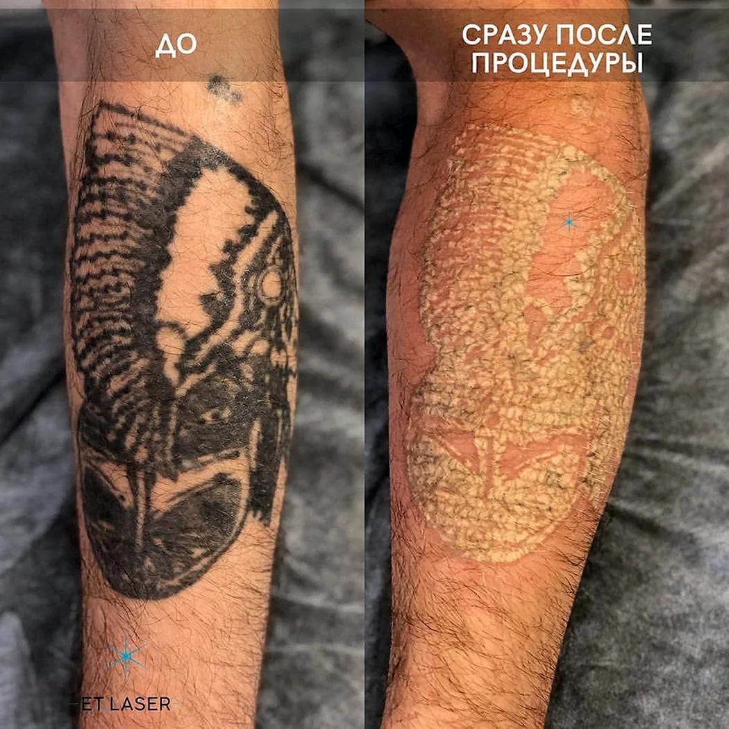 Сведение тату до и после