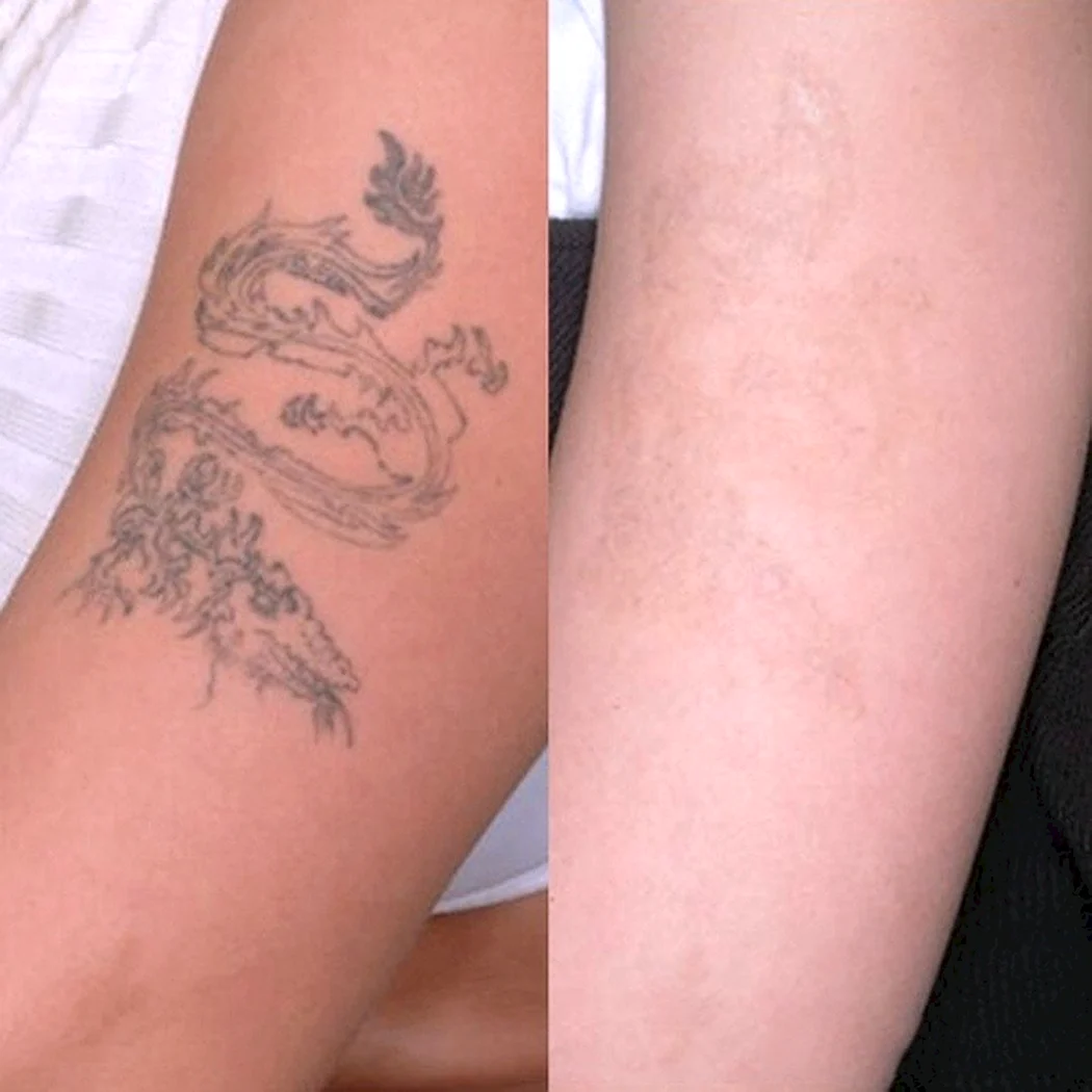 Сведение тату лазером до и после