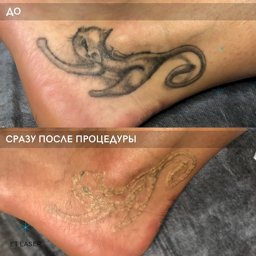 После свода тату лазером