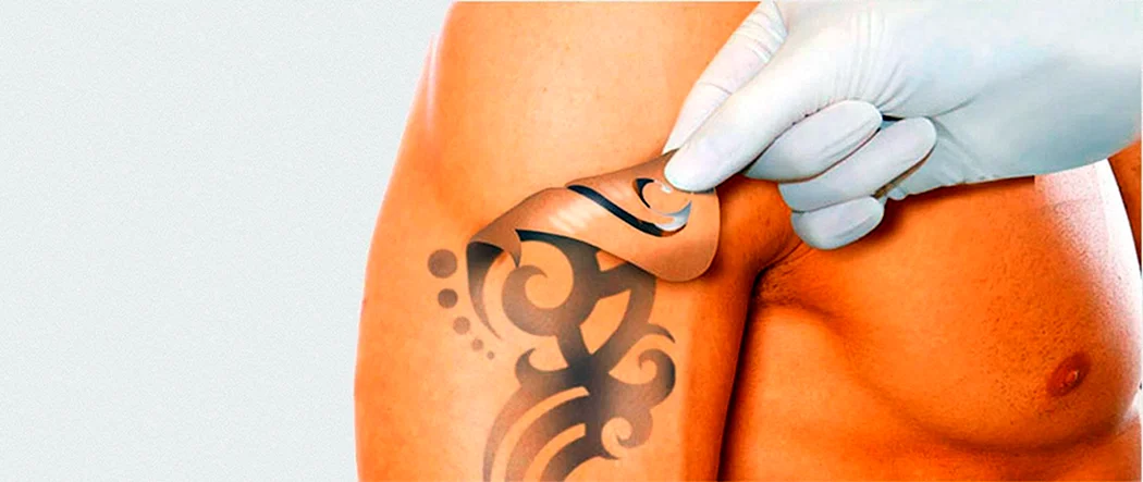Удаление татуажа и татуировок