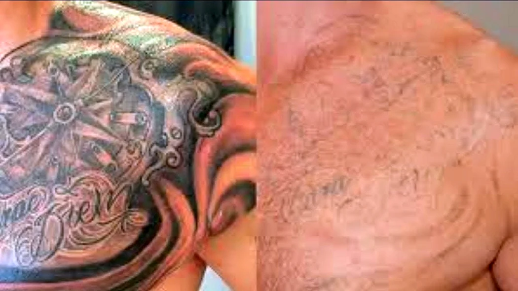 Сведение тату лазером до и после