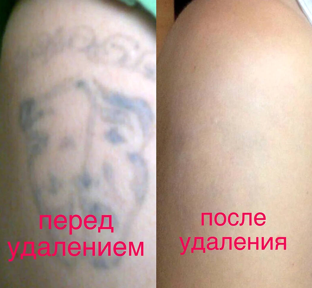 Высветление тату лазером