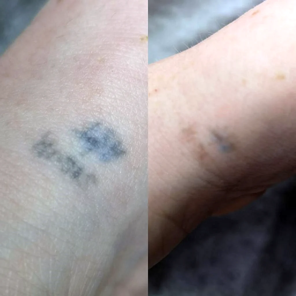 Татуировка почернения