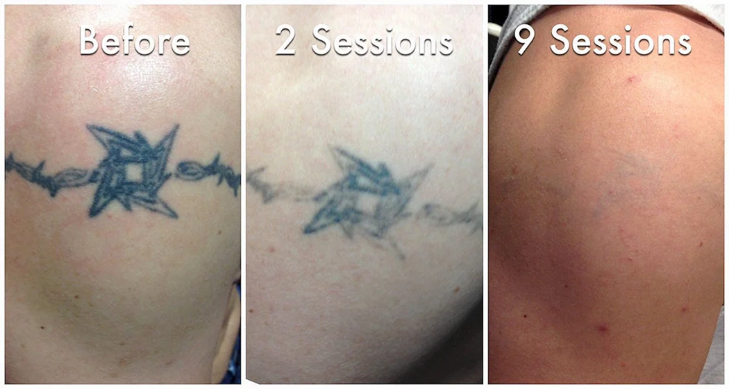 Сведение тату лазером Picosure