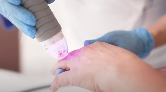 RF-ліфтинг: ефективне омолодження без болю і тривалої реабілітації