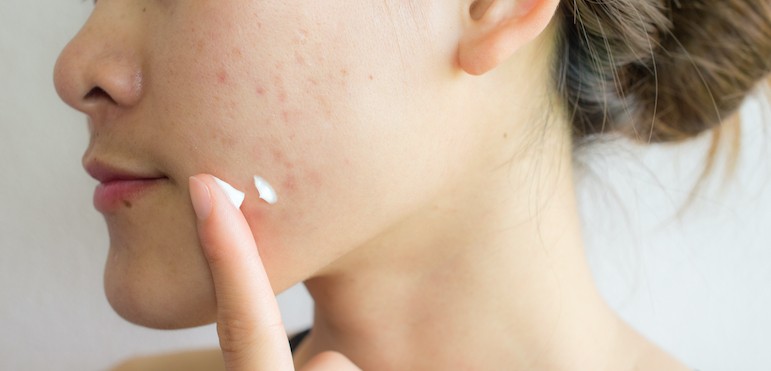 Акне у дорослих