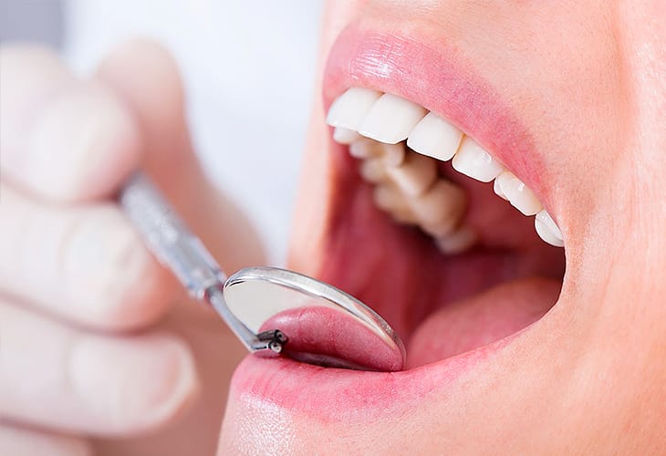 Художня реставрація зубів